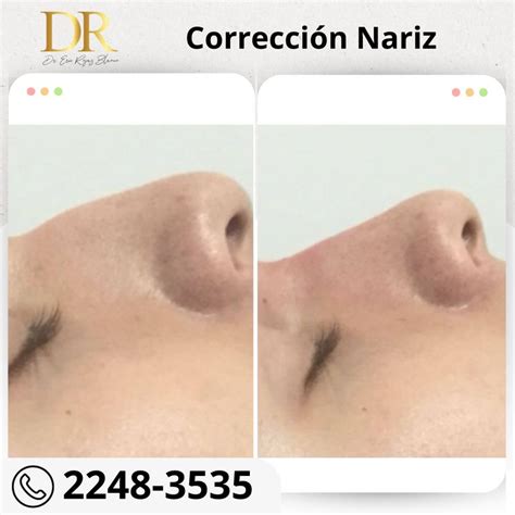 Rinolift Es El Procedimiento Ideal Para Mejorar El Perfil De Tu Nariz