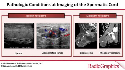 Pampiniform Plexus Ultrasound