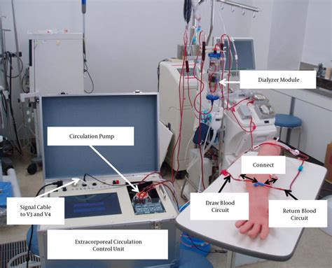 All View Of Extracorporeal Circulation System Apparatus And Blood