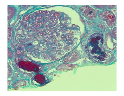 Microangiopathies Thrombotiques Imagedumois