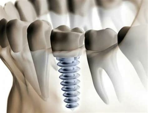 The Complete Guide To Dental Implant Types