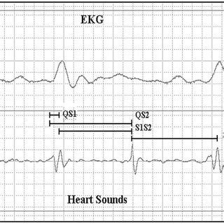 Simultaneous Recording Of Electrocardiogram EKG And Heart Sounds Used