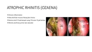 Acute And Chronic Rhinitis Pptx