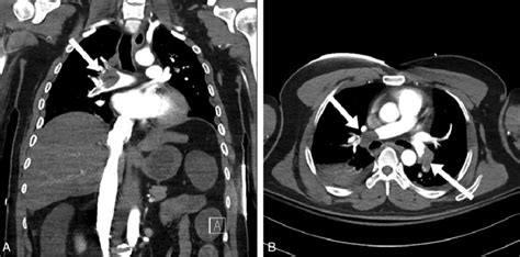 Chest Computed Tomography Scan Showing Extensive Bilateral Pulmonary Download Scientific