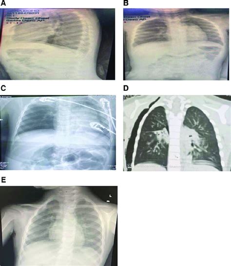 Chest Radiography And Ct Scan Were Performed For Case 3 Before During