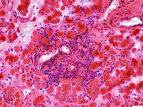 Thyroid Ophthalmopathy