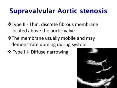 PPT - ECHOCARDIOGRAPHIC ASSESSMENT OF AORTIC VALVE STENOSIS PowerPoint ...