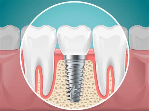 Benefits Of Dental Implants • Charleston Wv • Msofs