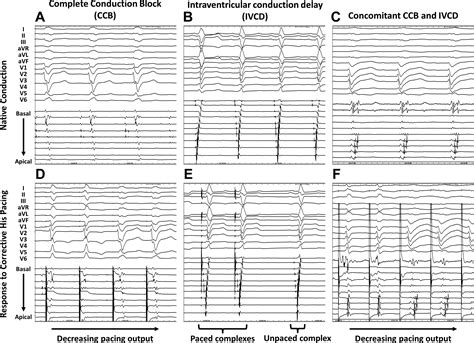 What Intracardiac Tracings Have Taught Us About Left Bundle Branch