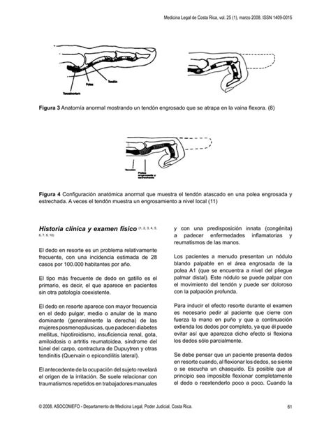 Tenosinovitis Estenosante Dedo En Resorte Pdf