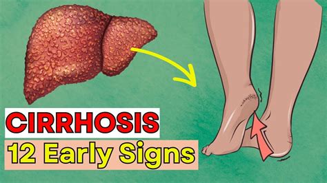 Don T Ignore 12 Early Signs Of Liver Cirrhosis Daily Joy Youtube