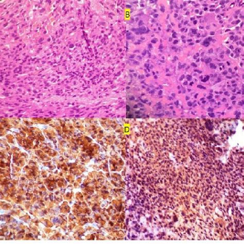 Histopathology Shows Tumor Composed Of Spindle And Pleomorphic Cells