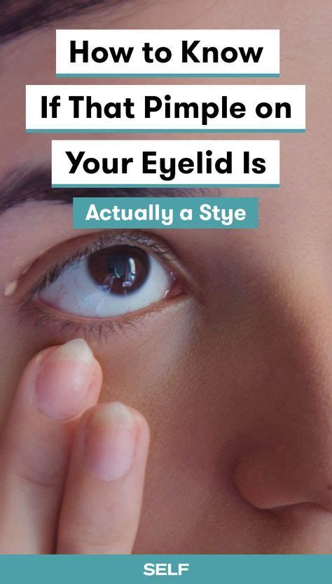 People Typically Use The Word Stye To Refer To What Ophthalmologists