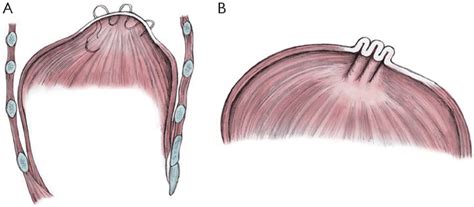 Figure 1 from Diaphragmatic plication for eventration or paralysis ...