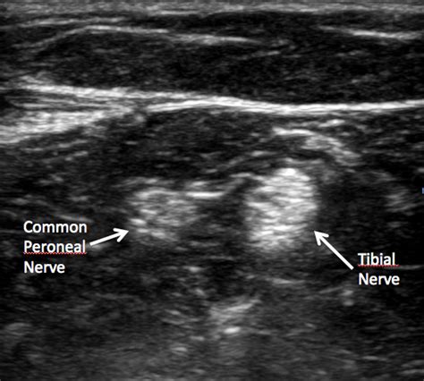 Learn Ultrasound Guided Popliteal Sciatic Nerve Blocks