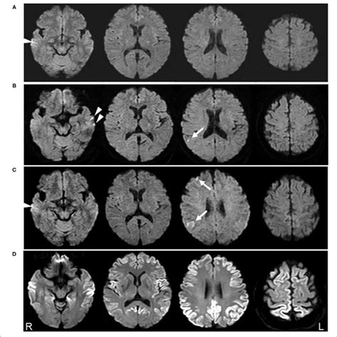 Serial Diffusion Weighted Images Dwi Of Brain Magnetic Resonance Download Scientific