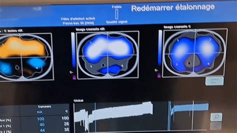 Electrical Impedance Tomography Dorsal Atelectasis Corrected With