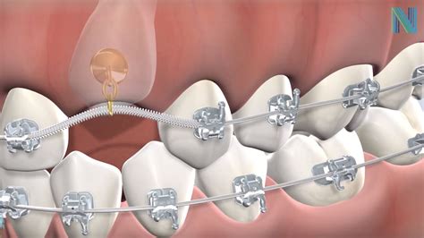 Guided Eruption Of Impacted Teeth In Fresno Ca Dr Greg Nalchajian