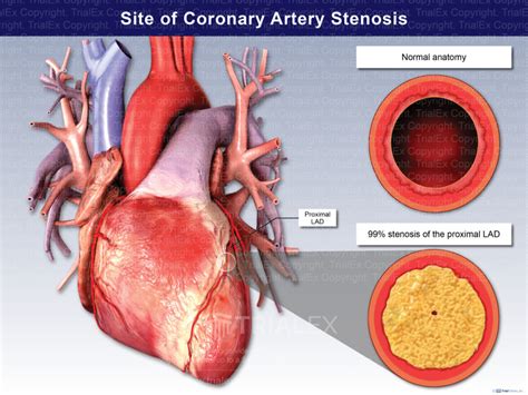 Site Of Coronary Artery Stenosis TrialQuest Inc