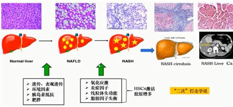 非酒精性脂肪性肝病病理诊断标准有何不同？刘秀萍教授超全解析两大系统 上海市医师协会网站
