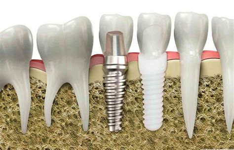 Zirconia Vs Titanium Implants Which Are Better Dental Care