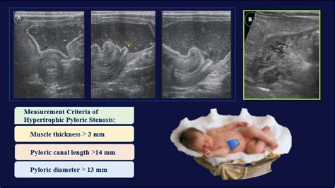 Target Sign In Pyloric Stenosis To Locate The Pylorus On Ultrasound