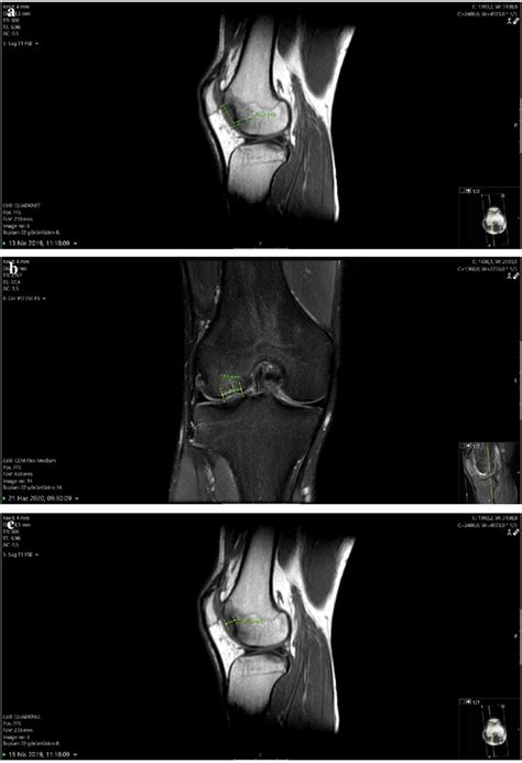 Measurement Of Cartilage Defect Size A Sagittal Plane B Coronal