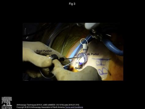 Hip Capsular Reconstruction Using Dermal Allograft Ppt Download