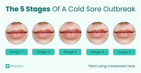 Cold Sore Stages Treatment