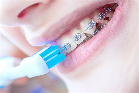 Self Ligating Braces