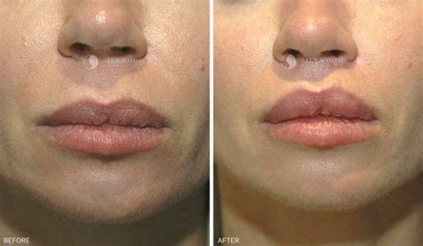 Lip Lift Sydney Before And After Gallery Dr Warwick Nettle Botox