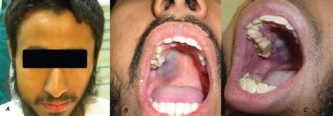 A Clinical Picture Of The Patient Showing Facial Asymmetry As Result Download Scientific