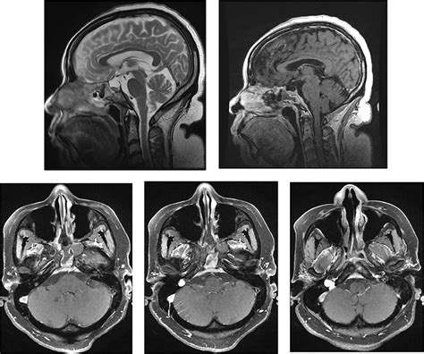 Mri Of The Head And Orbits Post Operatively Top Row Sagittal T2wi And Download Scientific