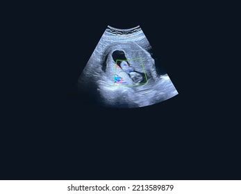 Little Baby Ultrasound 8 Weeks Gestation Stock Photo 2213589879 | Shutterstock