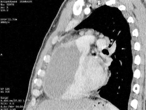 Ct Scan Showing Large Paratracheal Mediastinal Mass On The Right Side Download Scientific Diagram