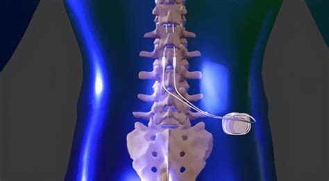 Spinal Cord Stimulation In Houston NW Surgery