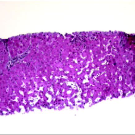 Nodular Regenerative Hyperplasia The Reticulin Stains Highlights