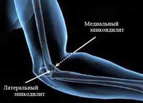 Эпикондилит: симптомы, признаки, прогноз — Онлайн-диагностика