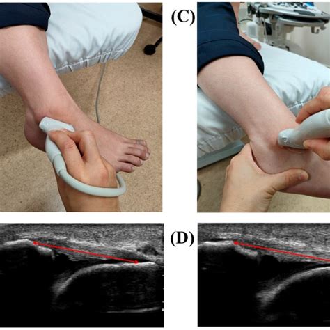 Ultrasonographic Evaluation Of The Anterior Talofibular Ligament