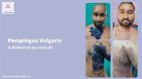 Pemphigus Vulgaris A Makeover Journey Youtube