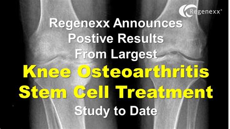 Stem Cell Treatment For Knees Osteoarthritis Kesileco