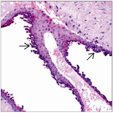 Hidrocystoma Apocrine And Eccrine Basicmedical Key