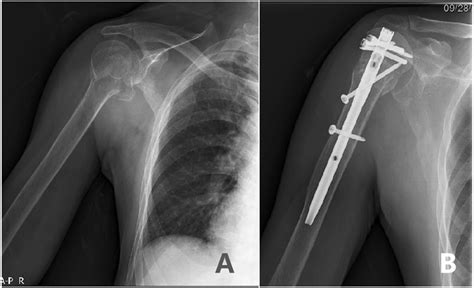 Surgical Position Of Lateral Tilted Supine Is Suitable For Proximal