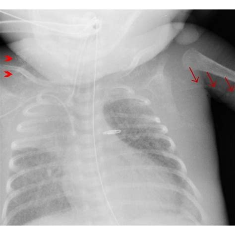 Chest X-ray shows chest soft tissue calcification (arrow heads) and... | Download Scientific Diagram