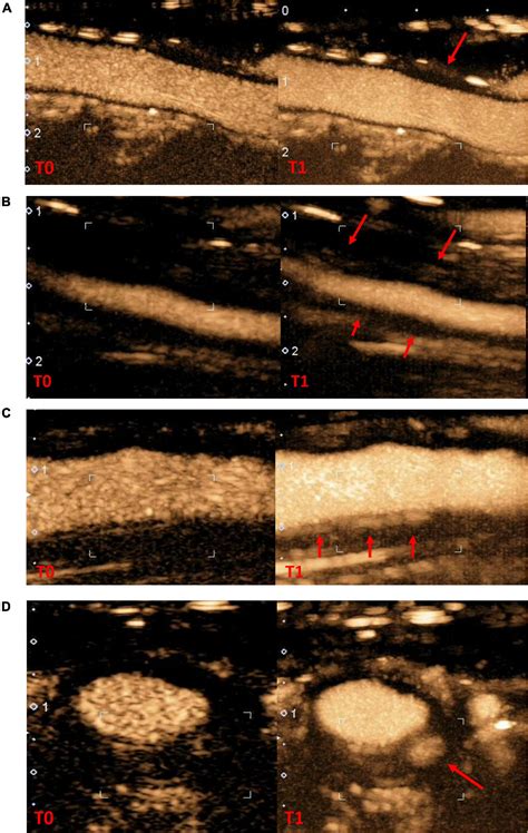 Frontiers Inter And Intra Observer Agreement Of Arterial Wall