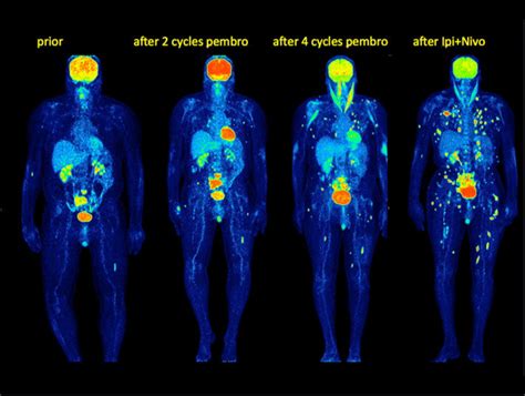 Maximum Intensity Projection Images Mip F Fdg Petct Images In A