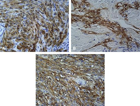 Positive Staining Of Tumor Stage Kaposi Sarcoma With Lymphatic Marker