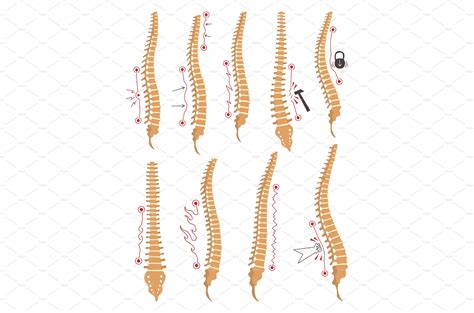 Spinal deformity types | Vector Graphics ~ Creative Market