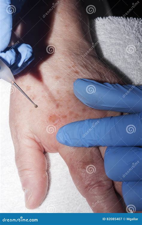 Removing Skin Diseases Stock Image Image Of Instrument 82085407