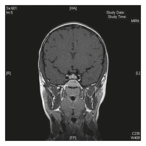 Coronal post-Gadolinium brain MRI image showing a normal pituitary... | Download Scientific Diagram